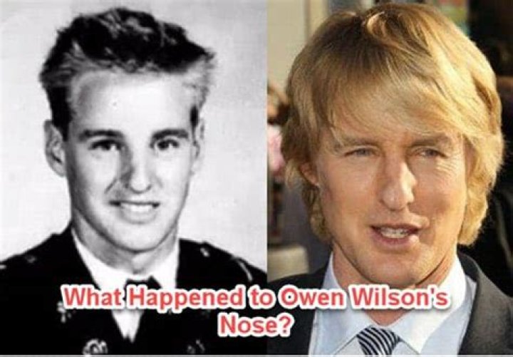 What Really Happen To Owen Wilson's Nose?